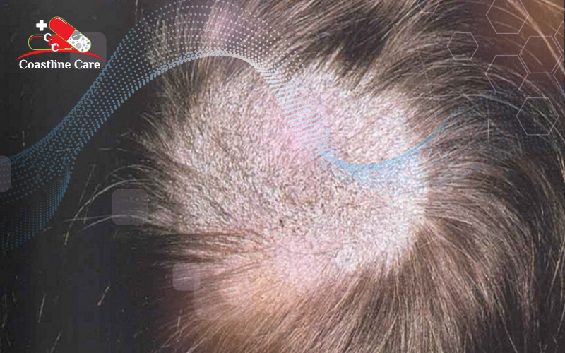 Serum giảm Rụng Tóc Kích Thích Mọc Tóc Dành Cho Nam Foltene Men Hair  Nhà  Thuốc Pharmedi