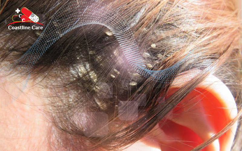 Nấm da đầu có lây không? Nó gây ảnh hưởng gì đến người bệnh?2