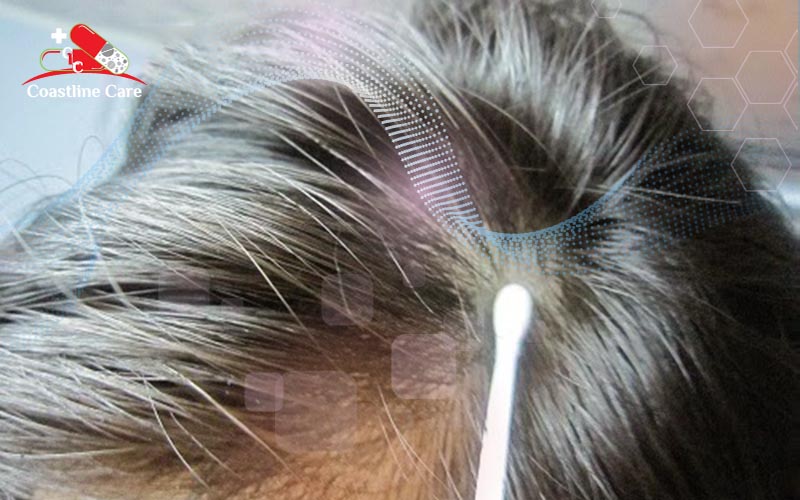 Nấm da đầu cách trị tận gốc hiệu quả cao3